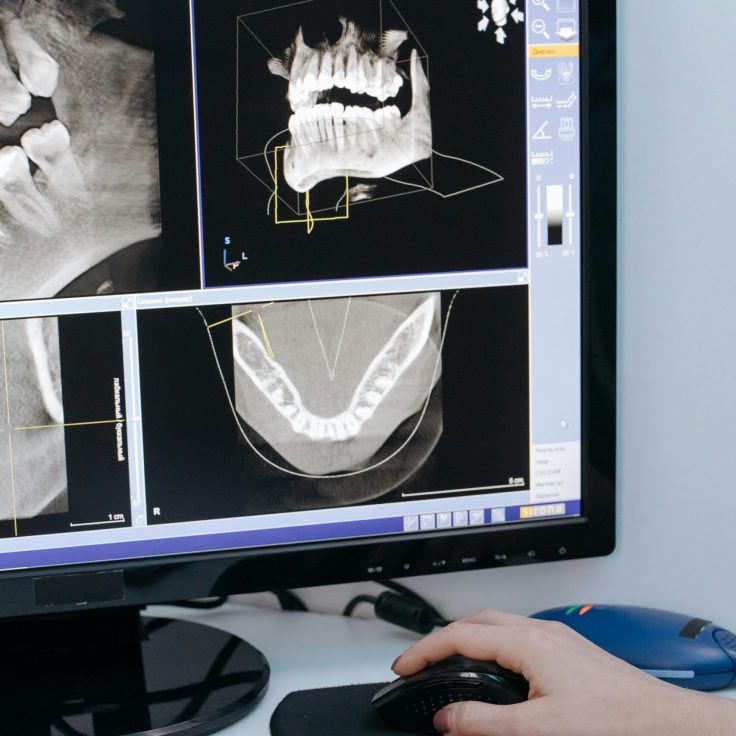 Dental implant crown restoration Houston