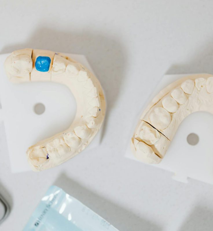 Porcelain veneer smile makeover Houston